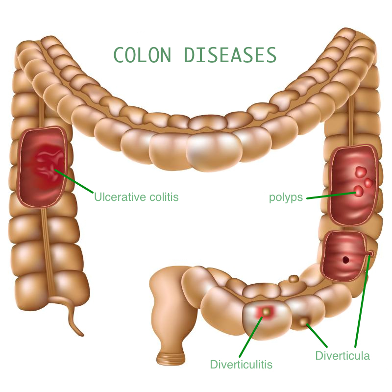 VO-colon-diseases-illustration
